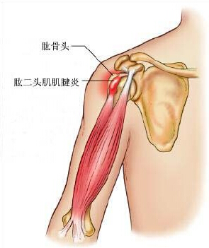 肌腱黏连