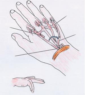 手指肌腱黏连