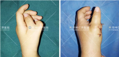 孩子多指如何治疗