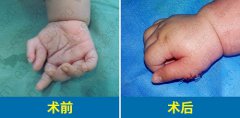 在线解答：新生儿六指