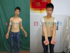 肘外翻什么时候治疗好